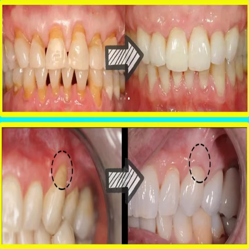 すぐに修復ガム血清後退する歯茎の再成長を和らげるドロップ歯を - Teeth Whitening With Baking Soda のレビューと価格