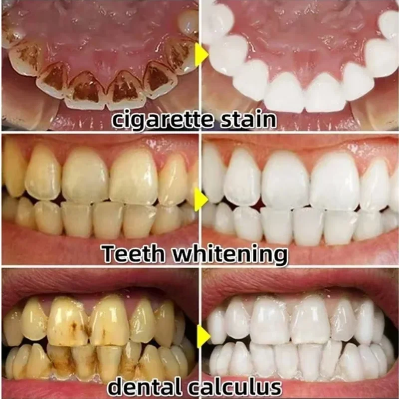 すぐに修復ガム血清後退する歯茎の再成長を和らげるドロップ歯を - Teeth Whitening With Baking Soda のレビューと価格