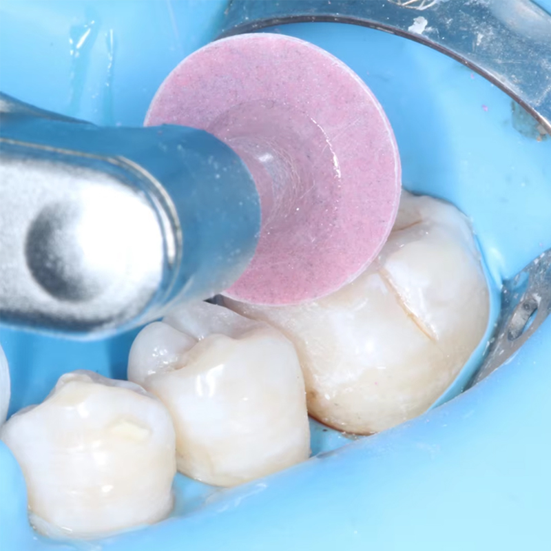 40個入り歯科研磨ディスク、コンポジットレジン仕上げ研磨ステ - Teeth Whitening Professional のレビューと価格