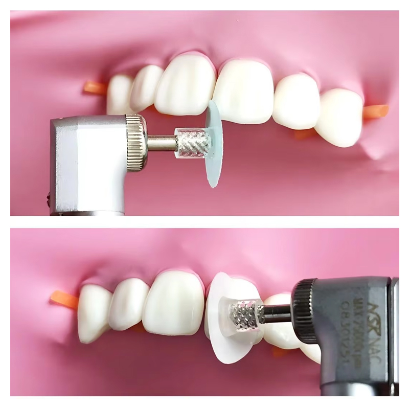40個入り歯科研磨ディスク、コンポジットレジン仕上げ研磨ステ - Teeth Whitening Professional のレビューと価格