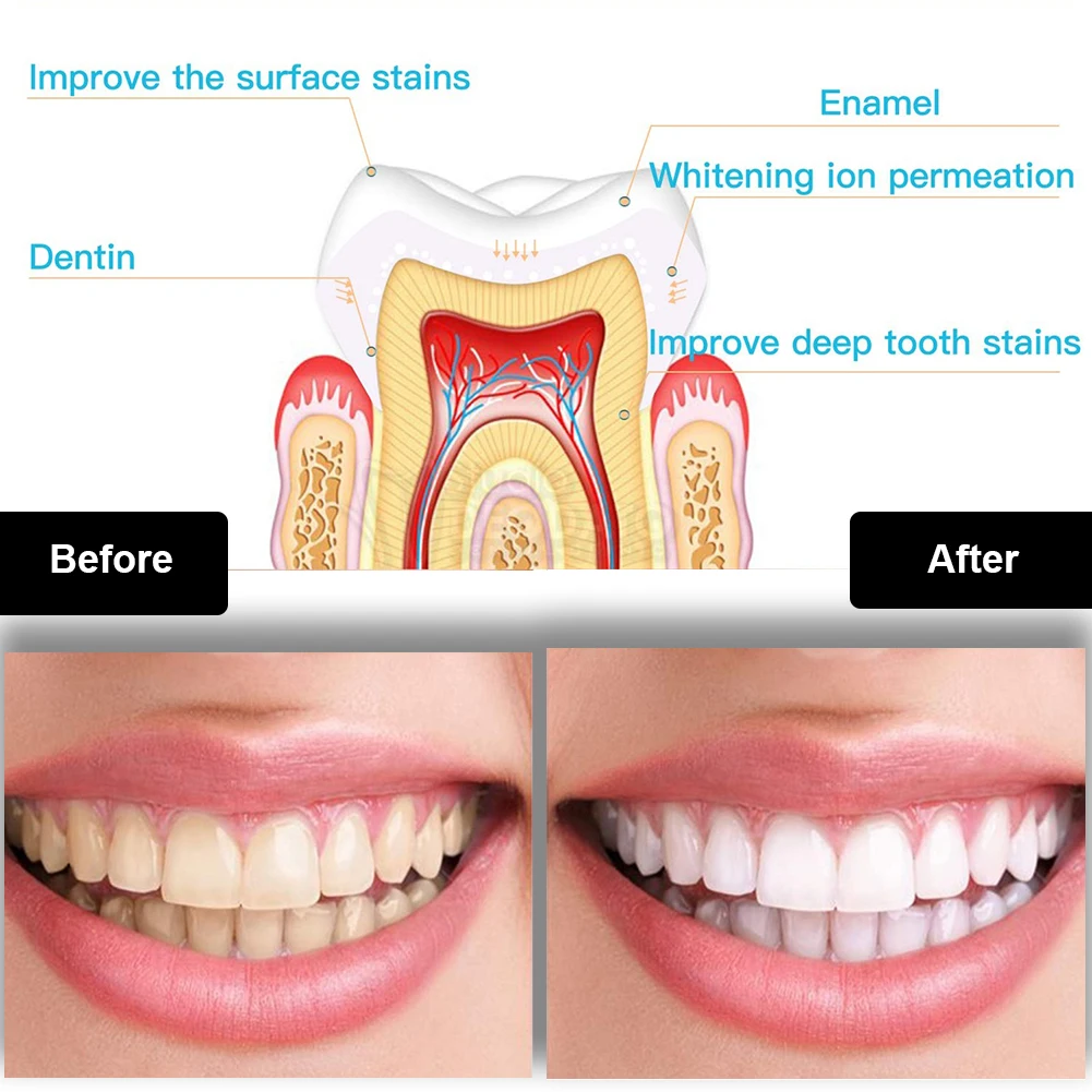 歯科歯ホワイトニングキットミニ 16 LED コールドライト - Teeth Whitening With Trays のレビューと価格