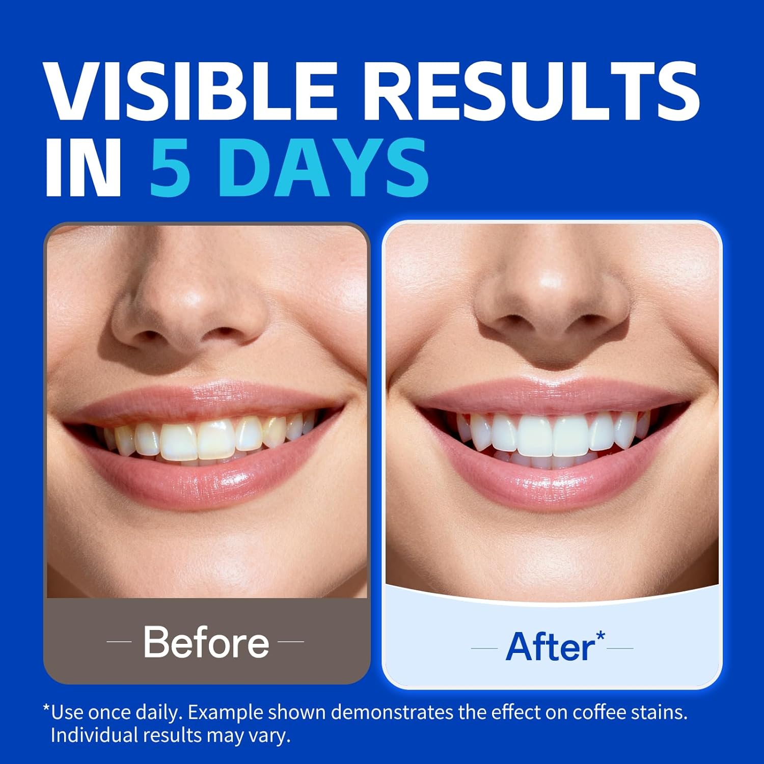 KHAZIX歯のホワイトニングストリップ7ペア、簡単装着スマ - Teeth Whitening Oil Pulling のレビューと価格